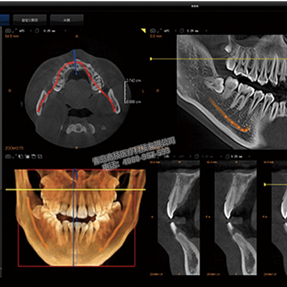 寧夏口腔CBCT 口腔全景機深圳菲森產品介紹大視野