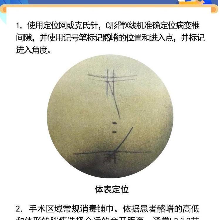 德國費格椎間孔內(nèi)窺鏡ZKJ-1型進口脊柱單入路可視微創(chuàng)主鏡